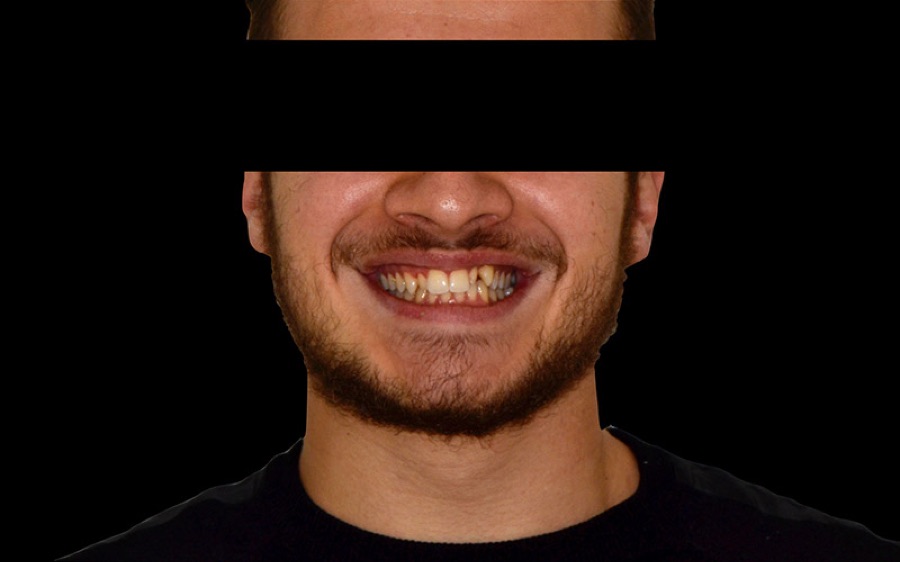 Sourire avant facettes