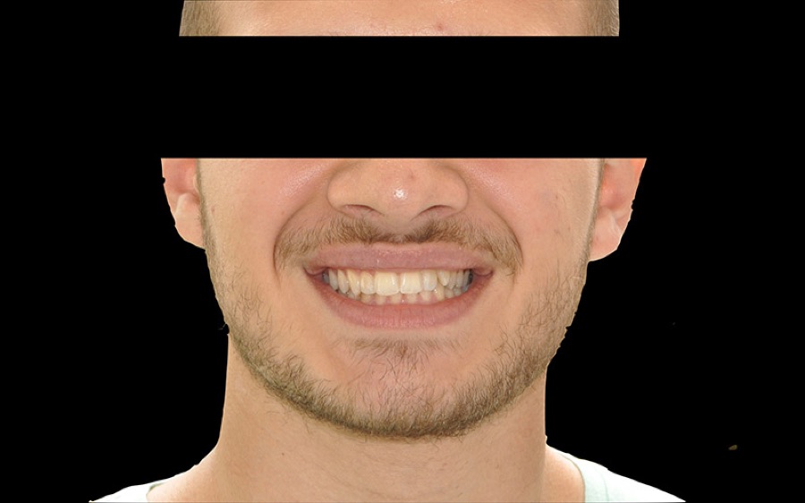 Sourire après facettes en céramique