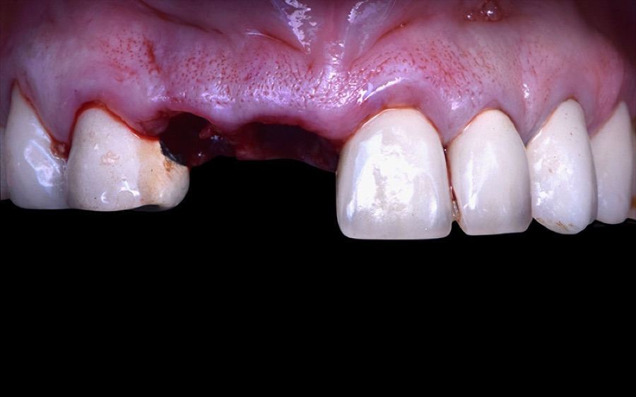 Dent manquante à l'avant avant la pose d'un implant