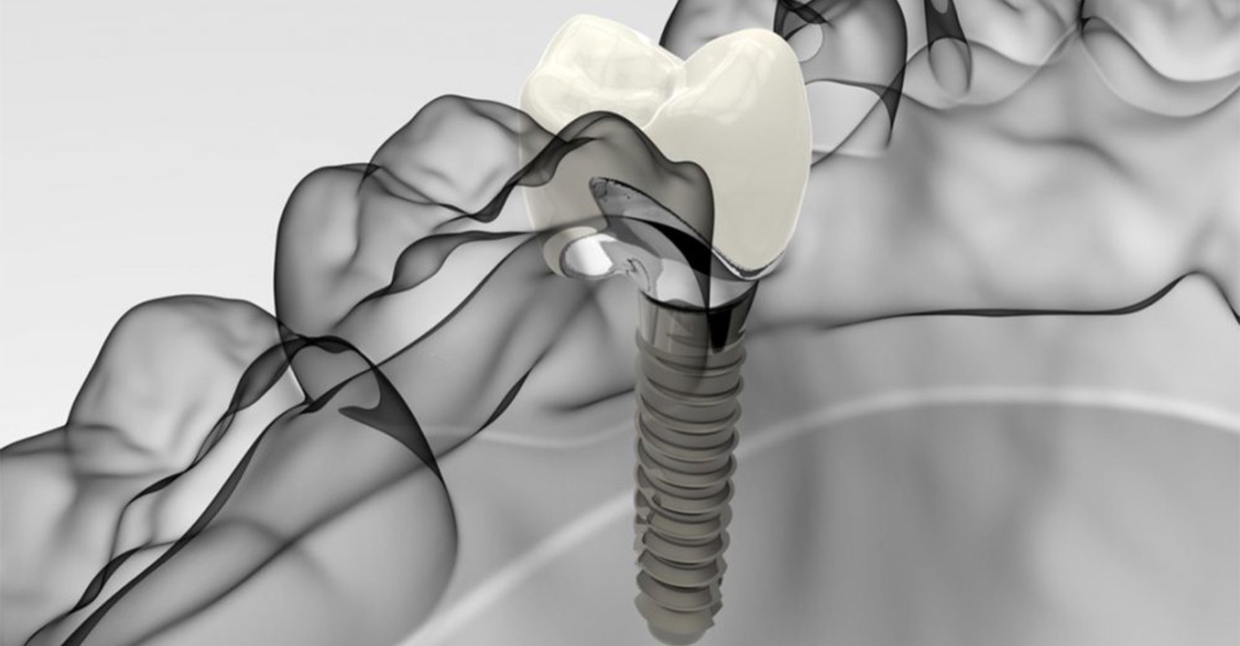 Implant dentaire